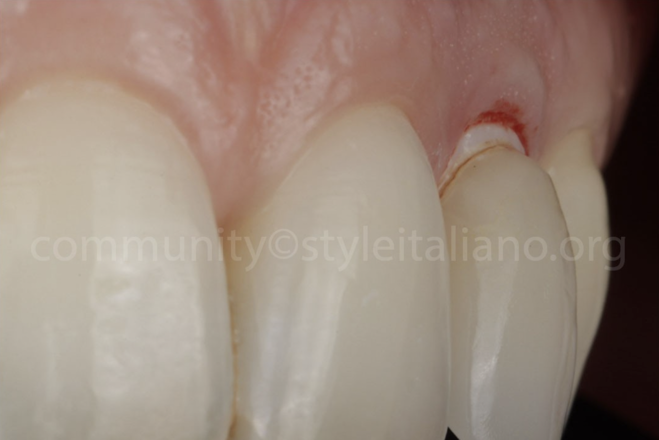 Điều Trị Lại Một Mão Răng Trên Implant: Tối ưu hoá kết quả bằng phần mềm OptiShade